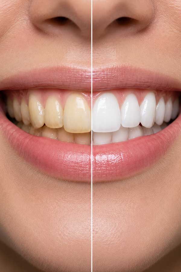 Laser teeth whitening treatment in a dental clinic in Antalya